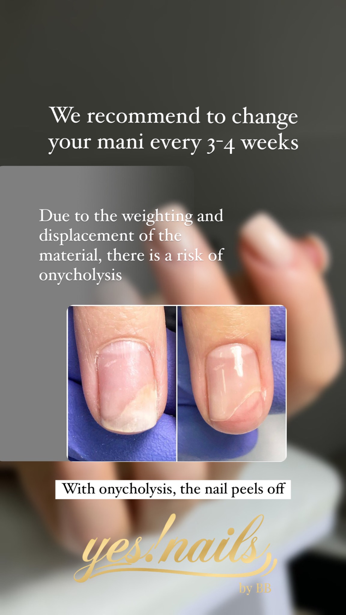 Zbliżenie dwóch paznokci z onycholizą, prezentujące oddzielanie się płytki paznokcia od łożyska. Na dłoniach ochronne, niebieskie rękawiczki.