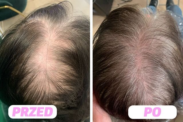 Porównanie stanu skóry głowy przed i po zabiegu, widoczne zagęszczenie włosów i zmniejszenie prześwitów na czubku głowy.