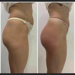 Zabiegi na ciało Pruszcz Gdański 1