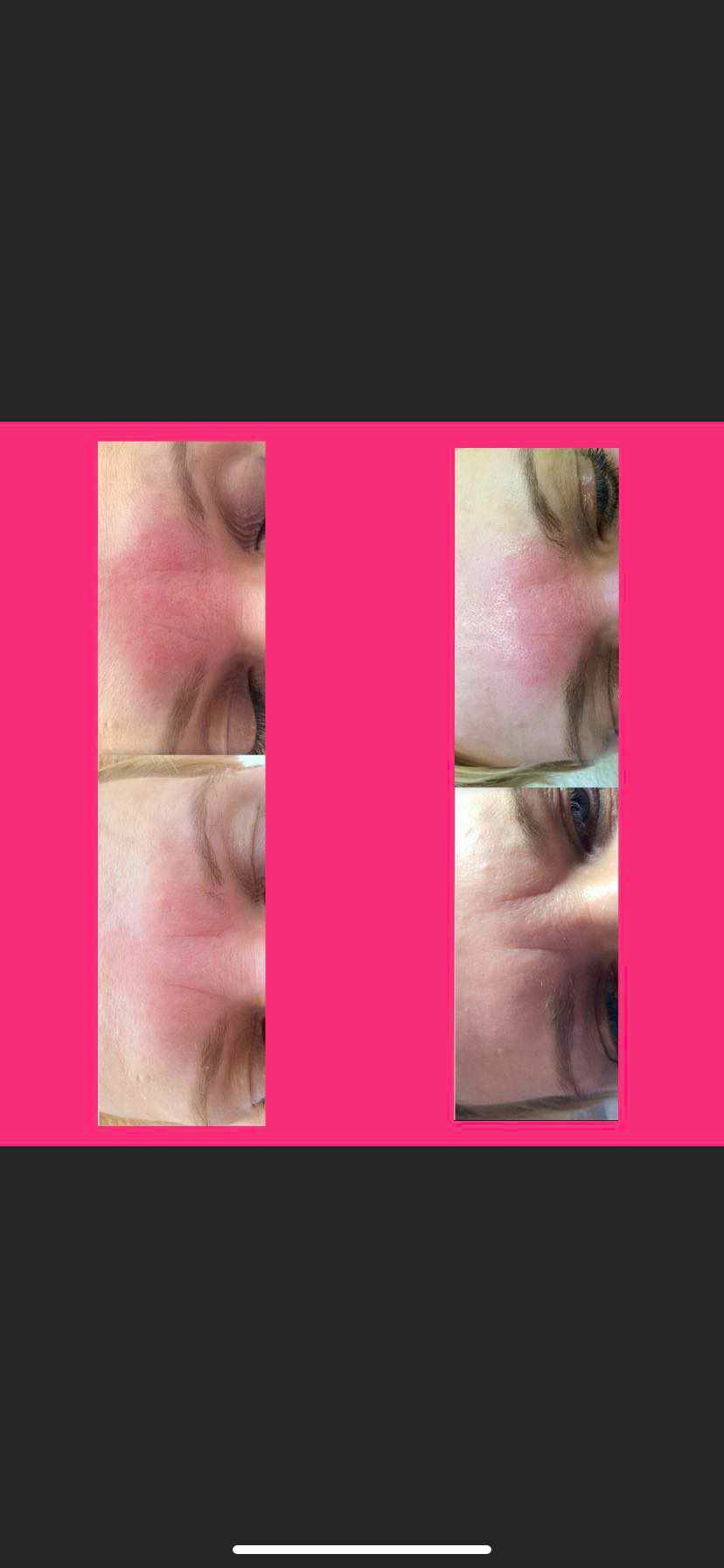 Kolaż przedstawiający fragment twarzy kobiety przed i po zabiegu kosmetycznym, z widocznym zaczerwienieniem skóry przed i złagodzeniem po zabiegu.