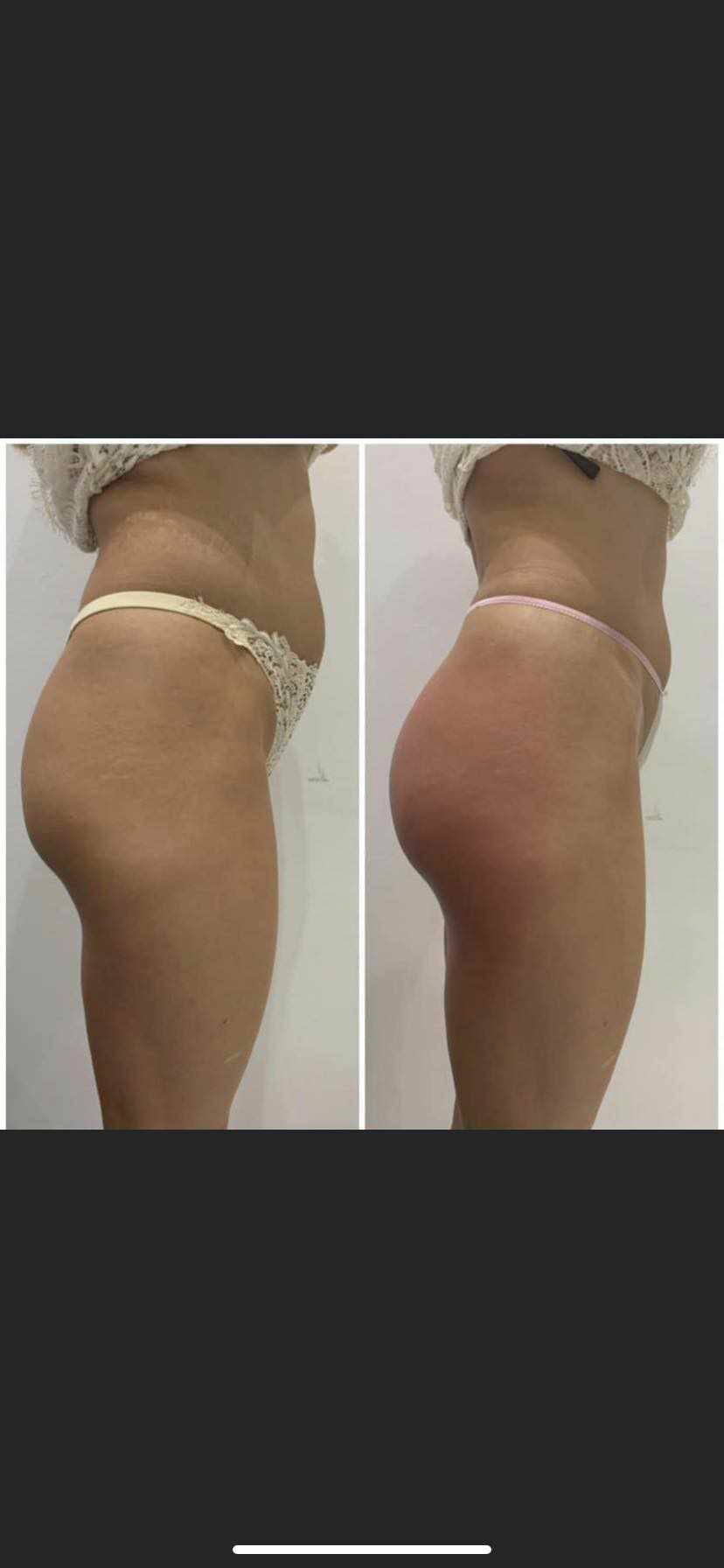 Zdjęcie typu 'przed i po' prezentujące efekt zabiegu modelowania pośladków, widoczne zmiany w kształcie i jędrności.