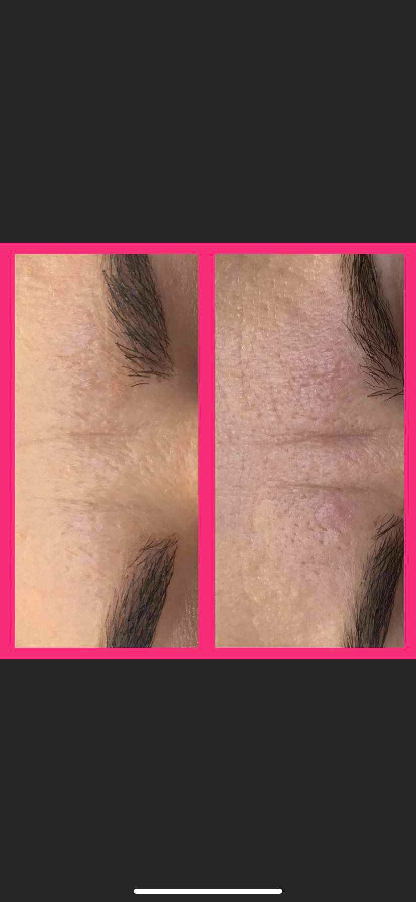 Zbliżenie na skórę czoła przed i po zabiegu, widoczne zmniejszenie zmarszczek i poprawa tekstury skóry.