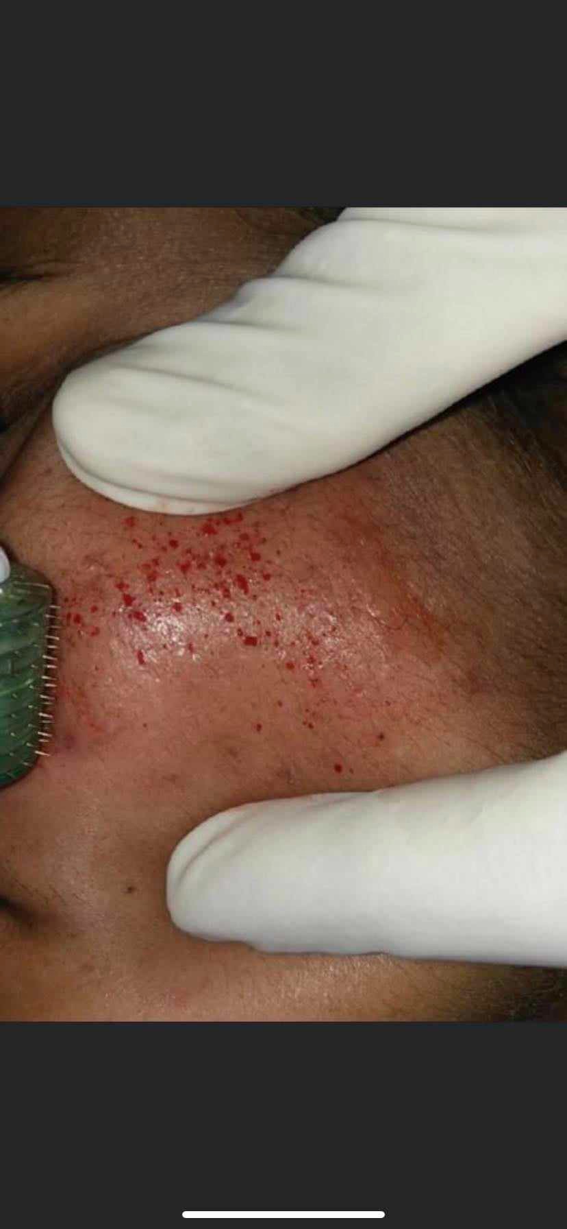 Dermapen na czole pacjenta, widoczne drobne krwawienia punktowe, dłonie w białych rękawiczkach przytrzymują skórę.