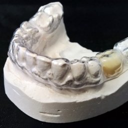 KarDent Lab & Academy - Model gipsowy szczęki z założoną przezroczystą nakładką ortodontyczną, widoczny ząb z koroną protetyczną.