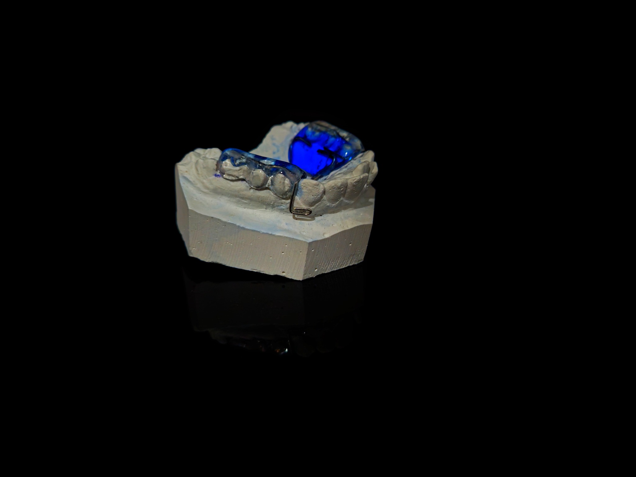 Model gipsowy szczęki z założonym przezroczystym aparatem ortodontycznym z metalowym elementem, oświetlonym niebieskim światłem, na czarnym tle.