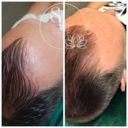 Nataliya Smaha - Porównanie stanu skóry głowy i włosów przed i po zabiegu trychologicznym, widoczne zagęszczenie i poprawa kondycji włosów, na zdjęciu widoczne logo firmy.