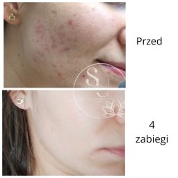 Nataliya Smaha - Porównanie skóry twarzy przed i po serii czterech zabiegów, widoczne zmniejszenie zaczerwienień i wyprysków, ujęcie z profilu.
