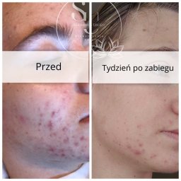 Nataliya Smaha - Porównanie stanu cery przed i tydzień po zabiegu kosmetycznym, widoczne zmniejszenie zmian trądzikowych.
