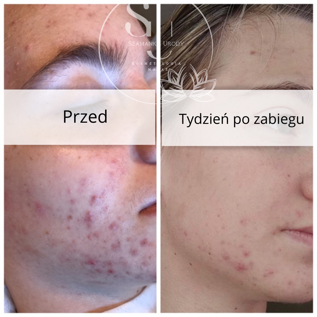 Porównanie stanu cery przed i tydzień po zabiegu kosmetycznym, widoczne zmniejszenie zmian trądzikowych.