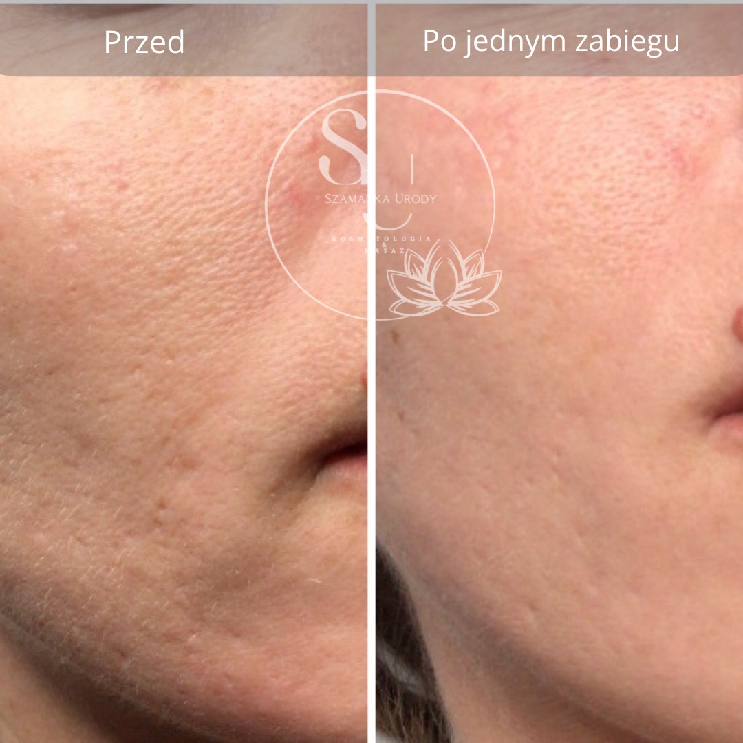 Porównanie skóry twarzy przed i po jednym zabiegu kosmetycznym, ukazujące redukcję zmarszczek i poprawę tekstury, z widocznym logo salonu kosmetycznego w tle.