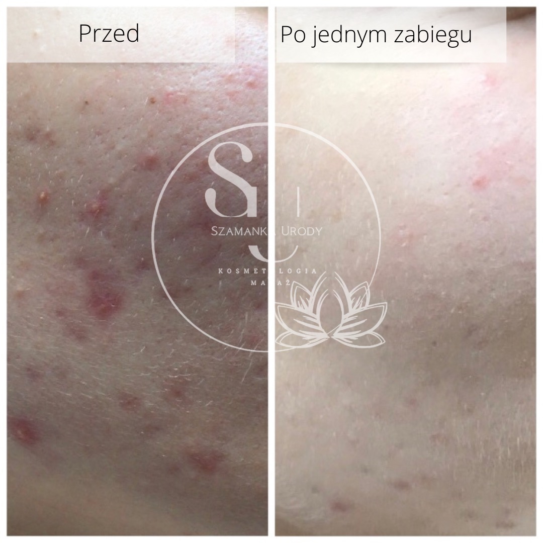 Porównanie stanu skóry przed i po jednym zabiegu kosmetycznym, uwzględniające logo firmy 'Szamanka Urody Kosmetologia Masaż' nałożone na zdjęcie.