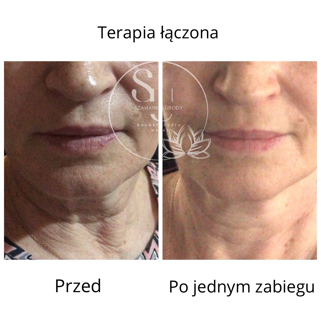 Zdjęcie 'przed i po' terapii łączonej: skóra szyi i podbródka z widoczną poprawą jędrności po jednym zabiegu, logo salonu w centralnej części.