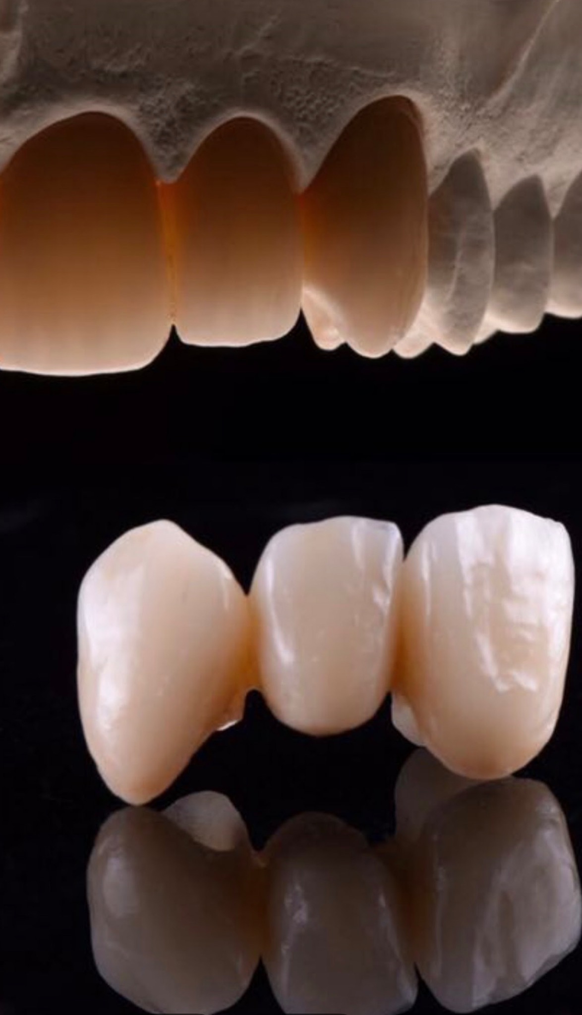 Ceramiczny most protetyczny z trzema zębami, widoczny na tle modelu gipsowego szczęki, ukazujący precyzję wykonania i estetykę uzupełnienia.