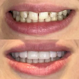 Zdjęcie przedstawia zbliżenie uśmiechu przed i po zabiegu. Górne zdjęcie pokazuje zęby z przebarwieniami i drobnymi nierównościami. Dolne zdjęcie prezentuje proste, białe zęby po założeniu licówek.