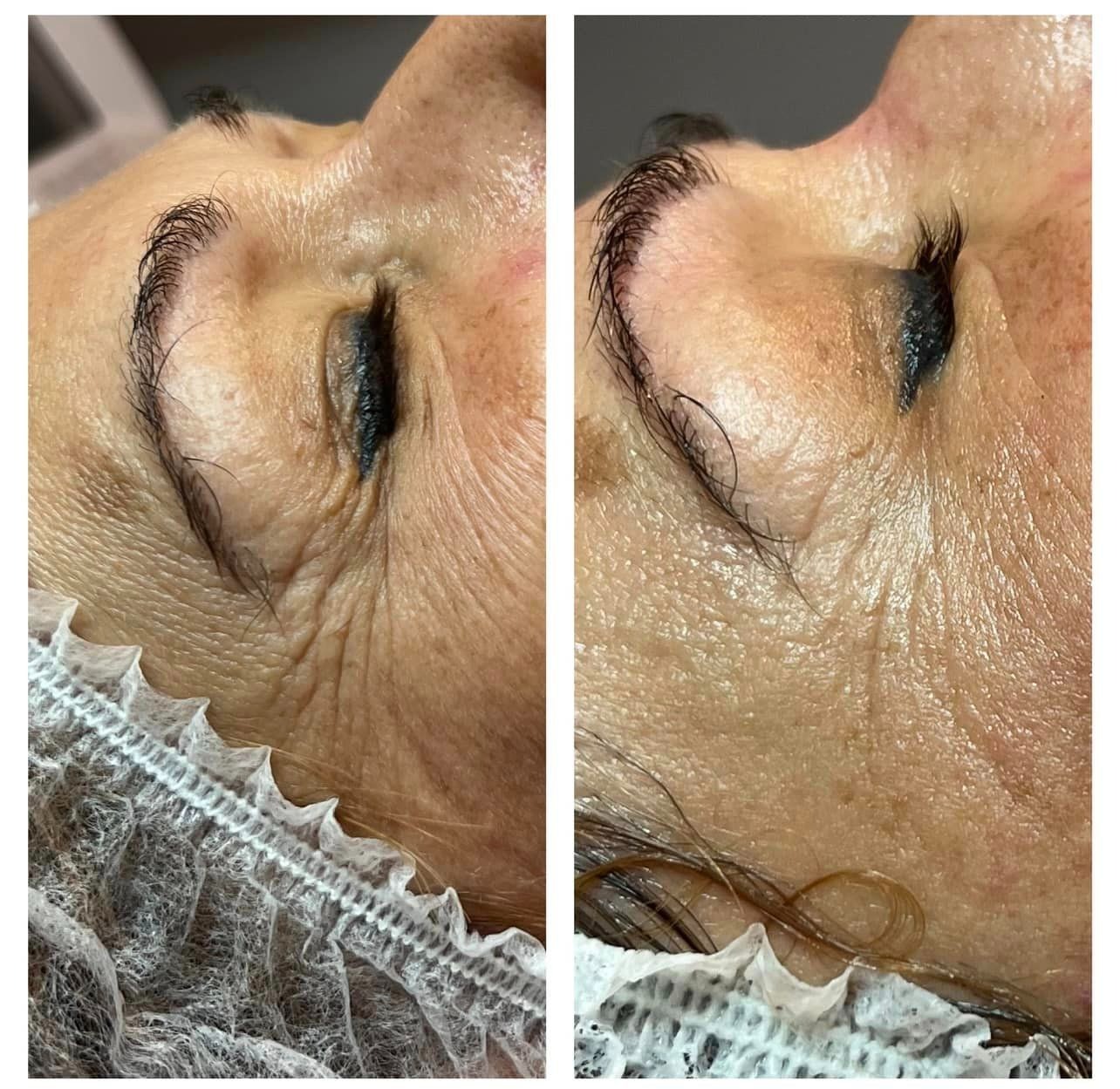 Efekt po 1 zabiegu Indiba na twarz.