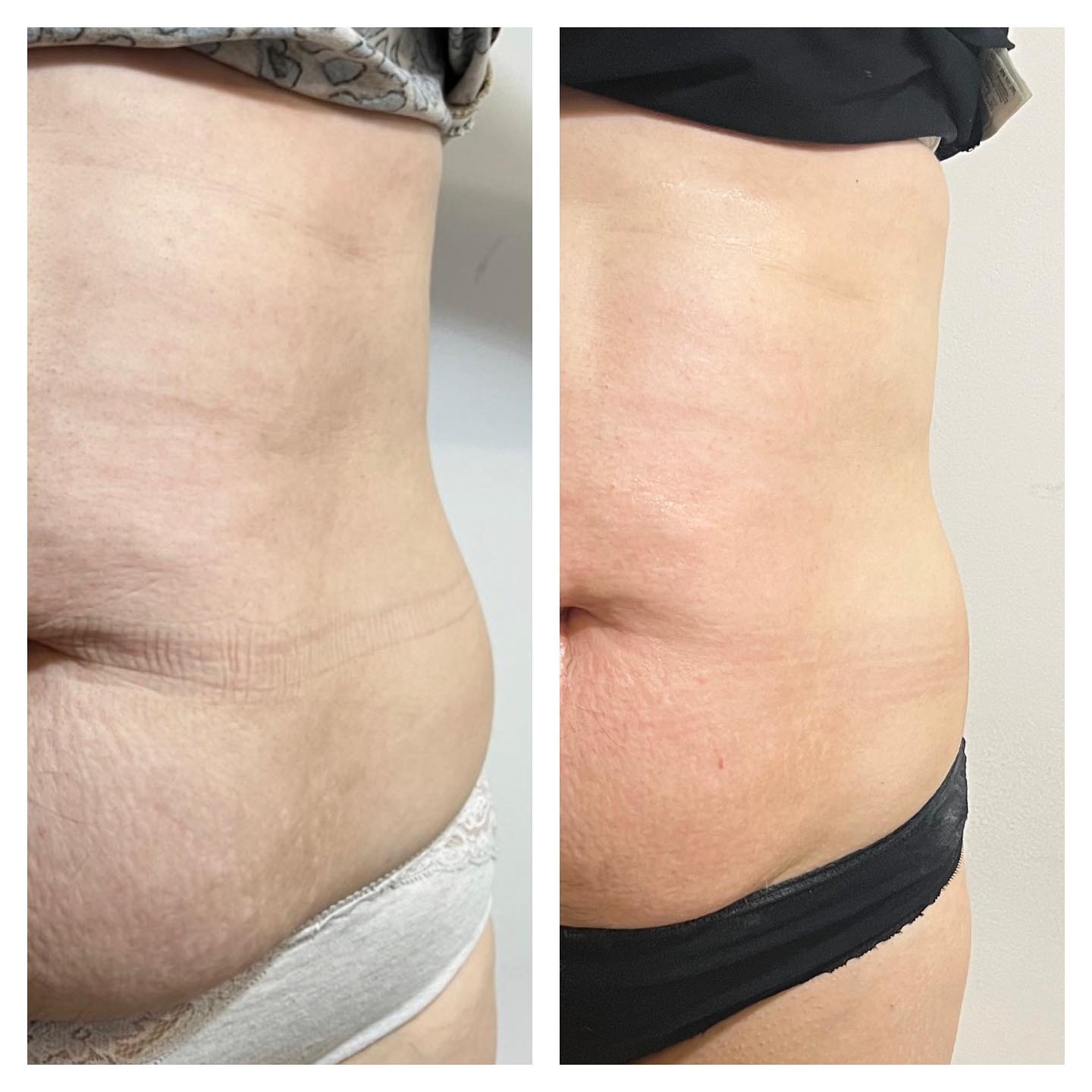 Efekt po 6 zabiegach Indiba na brzuch i boczki.