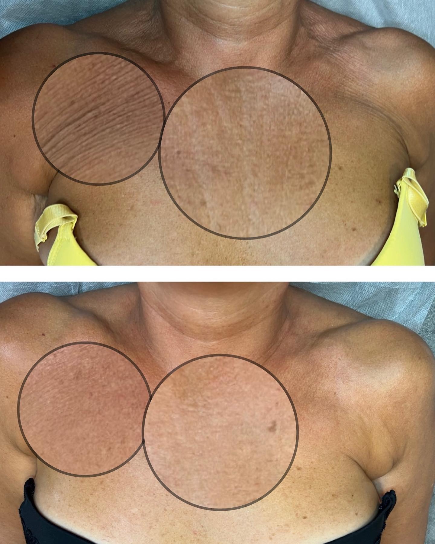 Efekt po 6 zabiegach Indiba na dekolt