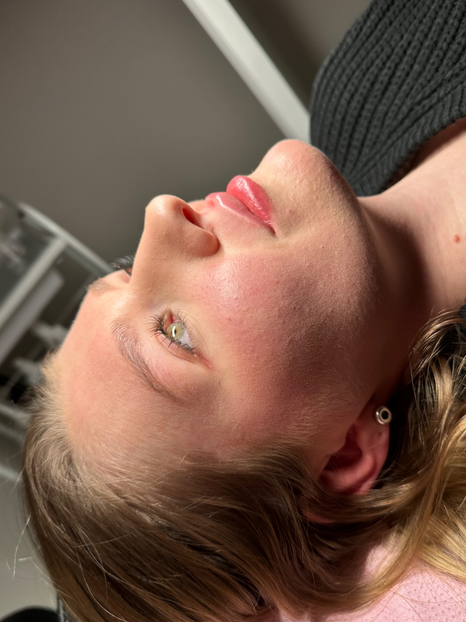 Zbliżenie na twarz kobiety leżącej podczas zabiegu powiększania ust, widoczne wypełnione usta z delikatnym połyskiem, skóra po zabiegu lekko zaczerwieniona, w uchu srebrny kolczyk.