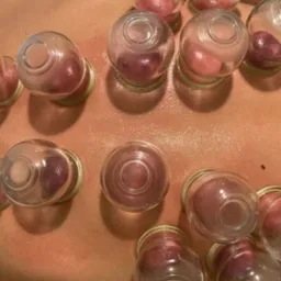 Plecy pacjenta z przyssawkami do masażu bańkami. Widoczne zaczerwienienia skóry wewnątrz baniek. Bliski kadr, naturalne światło.