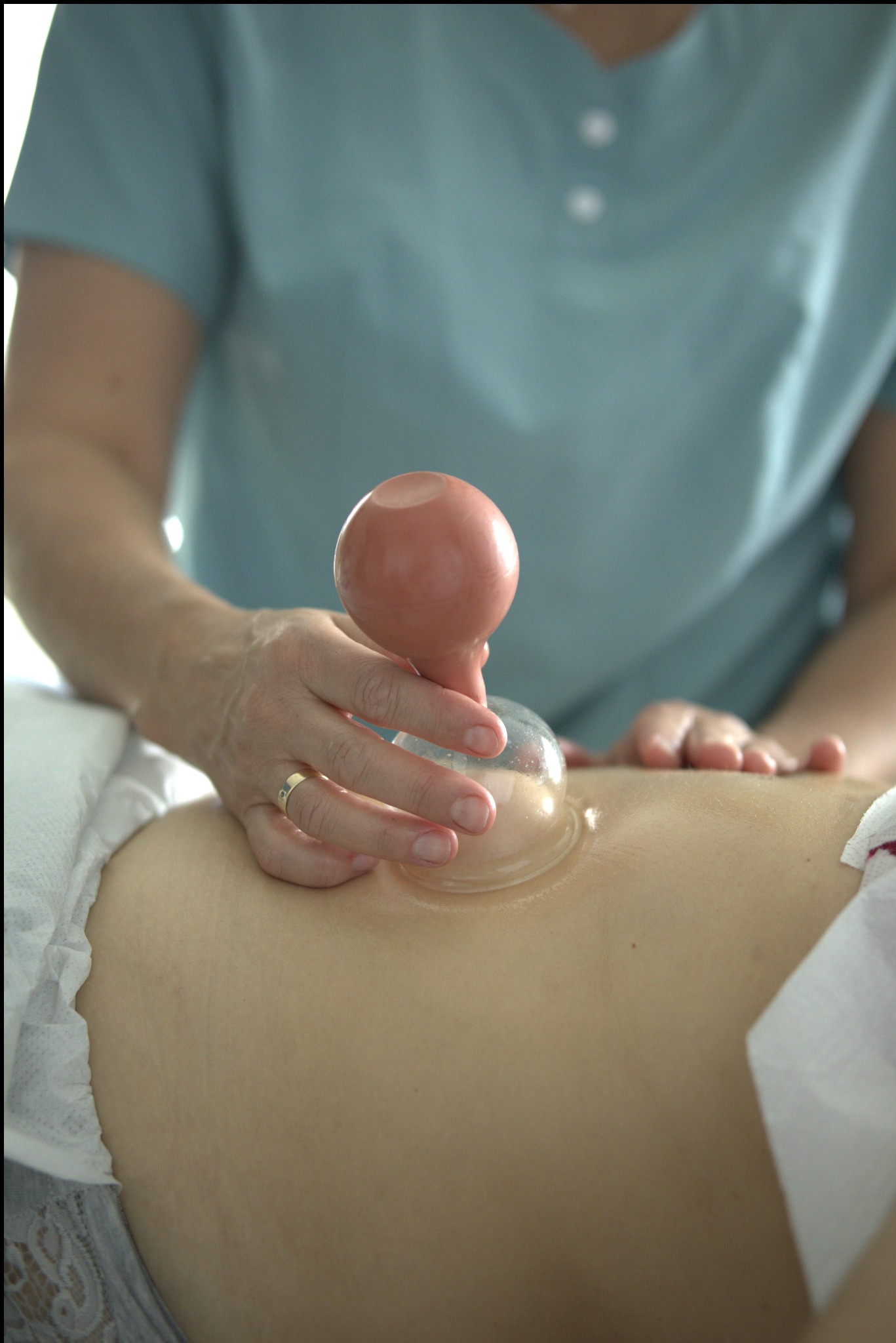 Terapia bańkami: dłoń terapeuty z pierścionkiem aplikuje bańkę na plecy pacjenta, w tle turkusowa koszulka medyczna i biała pościel.