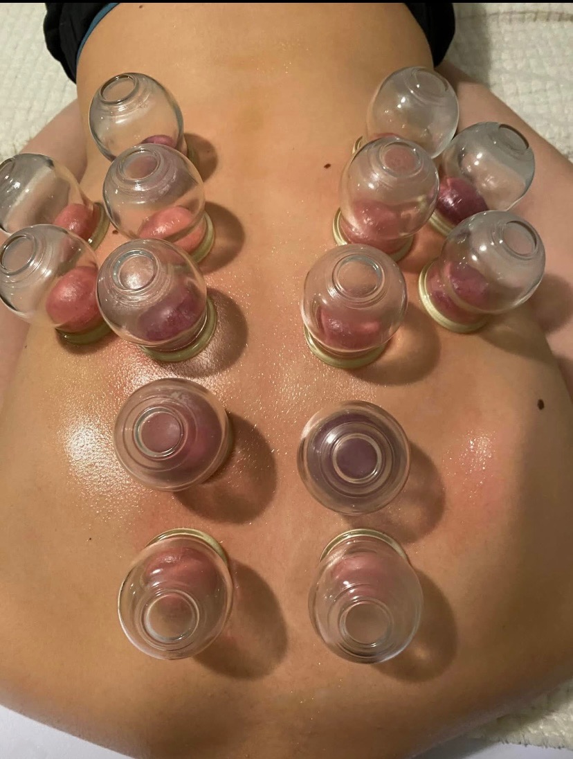 Plecy z bańkami próżniowymi, widoczne zaczerwienienia skóry wewnątrz szklanych naczyń. Terapia bańkami na tle jasnej powierzchni.