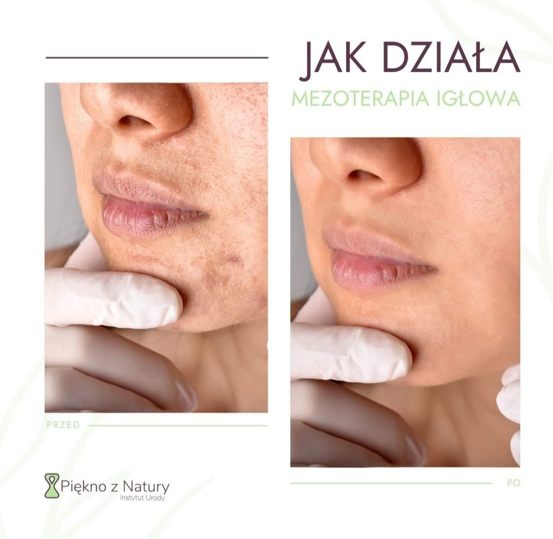 Porównanie skóry twarzy przed i po zabiegu mezoterapii igłowej, widoczne zmiany w pigmentacji i teksturze, ujęcie z bliska na dolną część twarzy, dłoń w białej rękawiczce dotyka podbródka.
