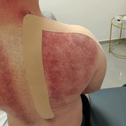 FIZJOTERAPIA PATRYCJA DUDZIK - Pacjent po zabiegu kinesiotapingu na ramieniu i górnej części pleców. Widoczne zaczerwienienia skóry i naklejone beżowe taśmy.