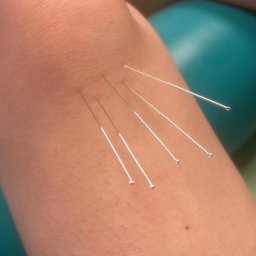 FIZJOTERAPIA PATRYCJA DUDZIK - Igły akupunkturowe wkłute w kolano pacjenta, widok z bliska, z boku widoczny fragment zielonego wałka.