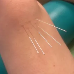 Igły akupunkturowe wkłute w kolano pacjenta, widok z bliska, z boku widoczny fragment zielonego wałka.