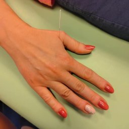 FIZJOTERAPIA PATRYCJA DUDZIK - Igła akupunkturowa wbita w dłoń z czerwonym manicure na tle zielonego podłoża.