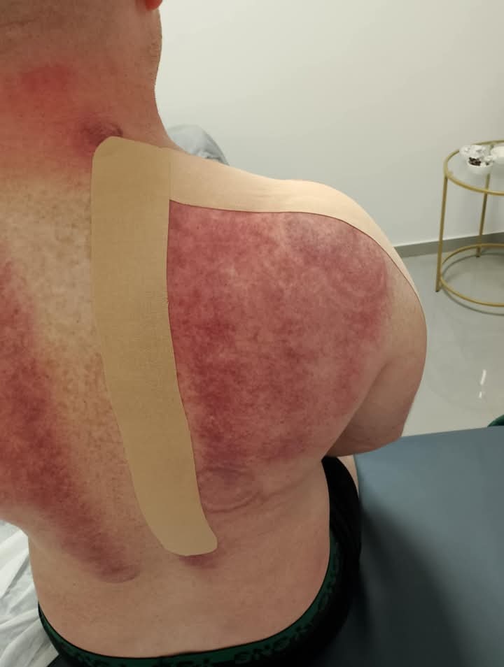 Pacjent po zabiegu kinesiotapingu na ramieniu i górnej części pleców. Widoczne zaczerwienienia skóry i naklejone beżowe taśmy.