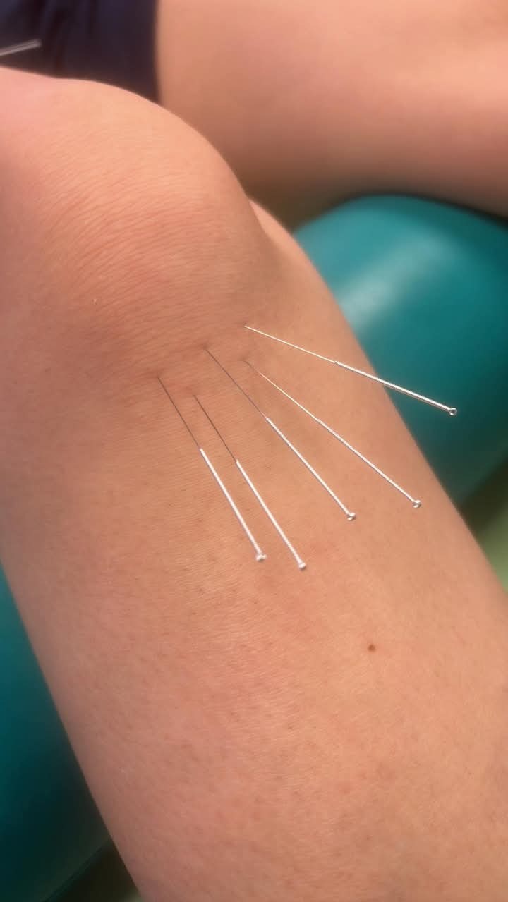 Igły akupunkturowe wkłute w kolano pacjenta, widok z bliska, z boku widoczny fragment zielonego wałka.