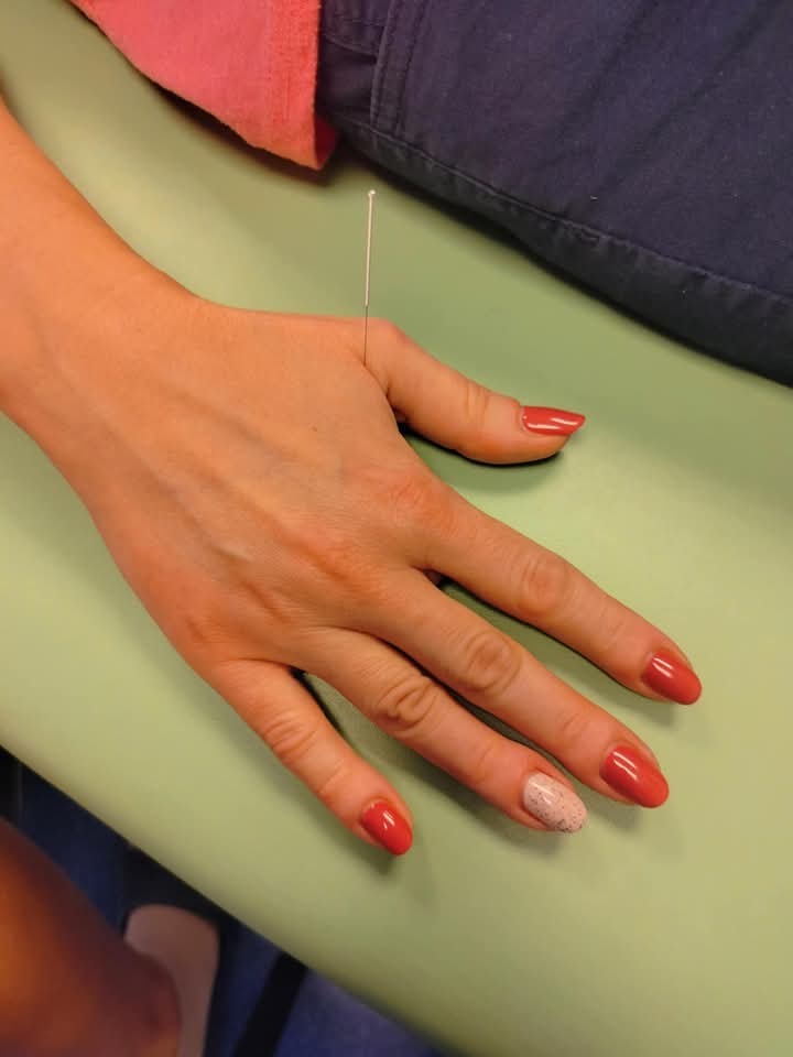 Igła akupunkturowa wbita w dłoń z czerwonym manicure na tle zielonego podłoża.