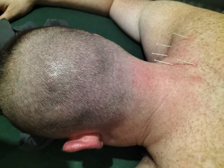 Mężczyzna leżący na zielonym podłożu z igłami do akupunktury w okolicy szyi i ramion.