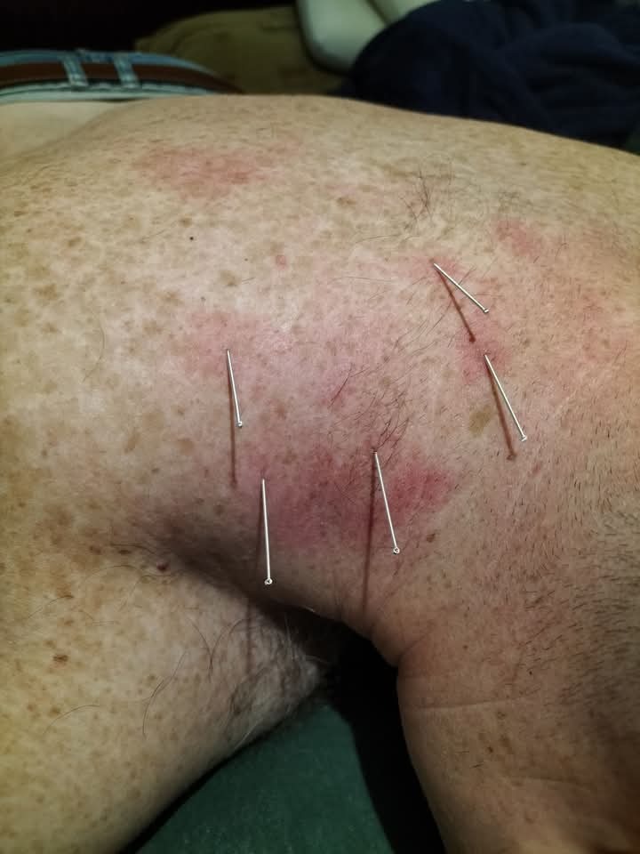 Fragment ciała pacjenta z widocznymi cienkimi igłami akupunkturowymi wbitymi w skórę, w okolicy widoczne zaczerwienienia.