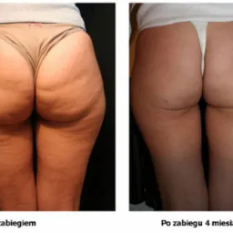 Porównanie wyglądu pośladków i ud przed i po zabiegu lipolizy iniekcyjnej, widoczna redukcja cellulitu i poprawa jędrności skóry po 4 miesiącach.