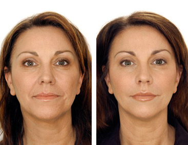 Zdjęcie przedstawia porównanie twarzy kobiety przed i po zabiegu lipolizy iniekcyjnej. Po lewej stronie widoczna twarz z widocznymi zmarszczkami i bruzdami, po prawej stronie twarz po zabiegu...