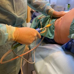 Medi Medic Centrum Medyczne - Lekarz w rękawiczkach wykonuje zabieg liposukcji na boku pacjenta, widoczna kaniula i dreny z płynem, tło to sterylne otoczenie gabinetu.