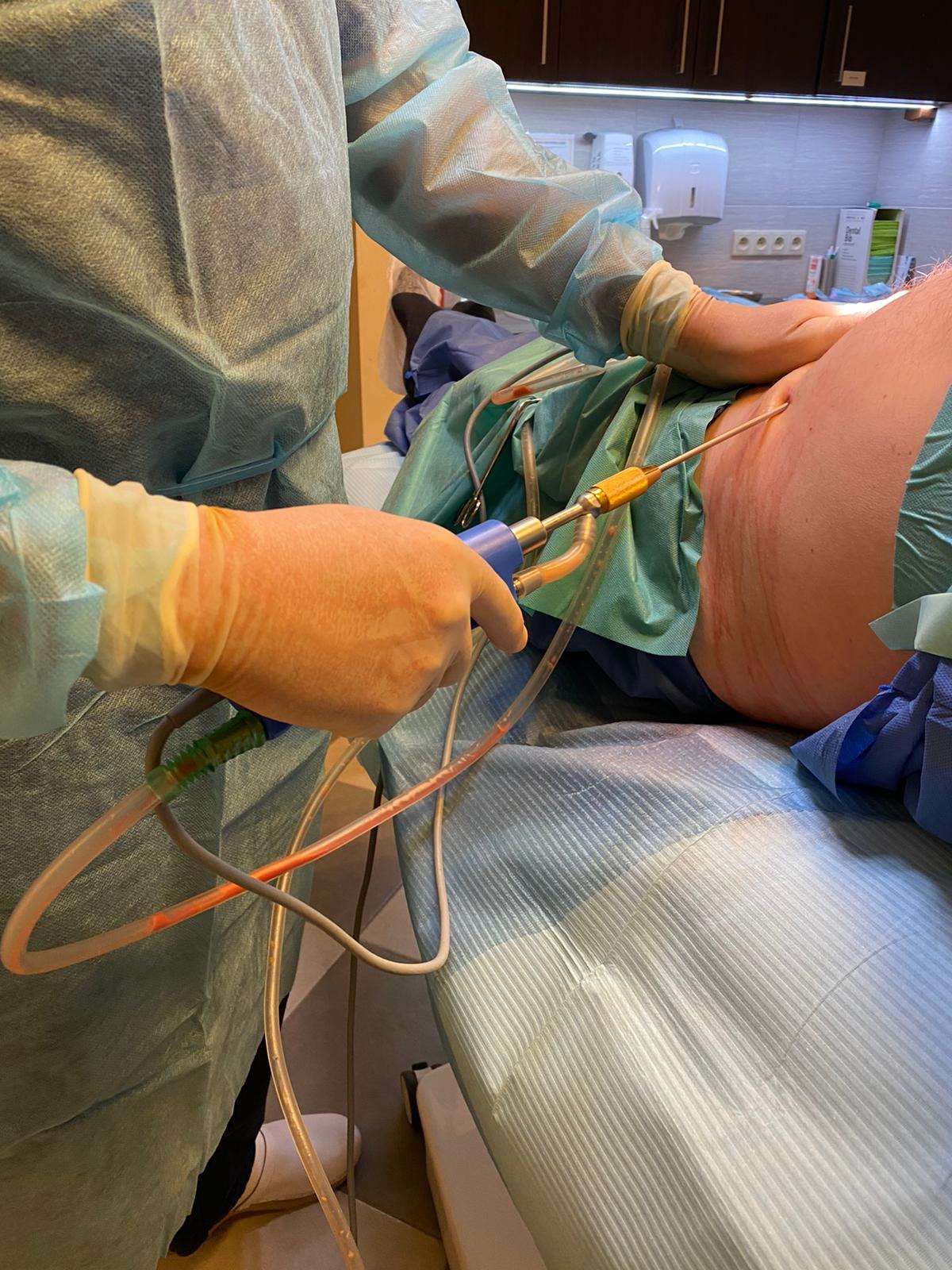 Lekarz w rękawiczkach wykonuje zabieg liposukcji na boku pacjenta, widoczna kaniula i dreny z płynem, tło to sterylne otoczenie gabinetu.