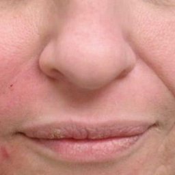 Jedna strona twarzy po wypełnieniu kwasem hialuronowym