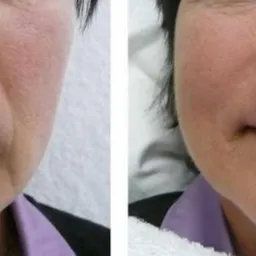 Wypełnienie zmarszczek kwasem hialuronowym