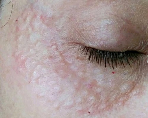 Bliski kadr skóry pod okiem, widoczne ślady po zabiegu mezoterapii igłowej, zaczerwienienia i niewielkie grudki.