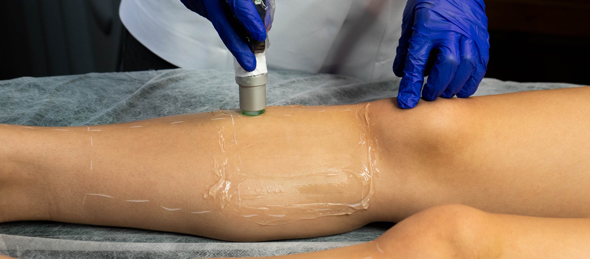 Noga pacjentki posmarowana żelem, przygotowana do zabiegu urządzeniem z głowicą, wykonywanego przez osobę w niebieskich rękawiczkach.