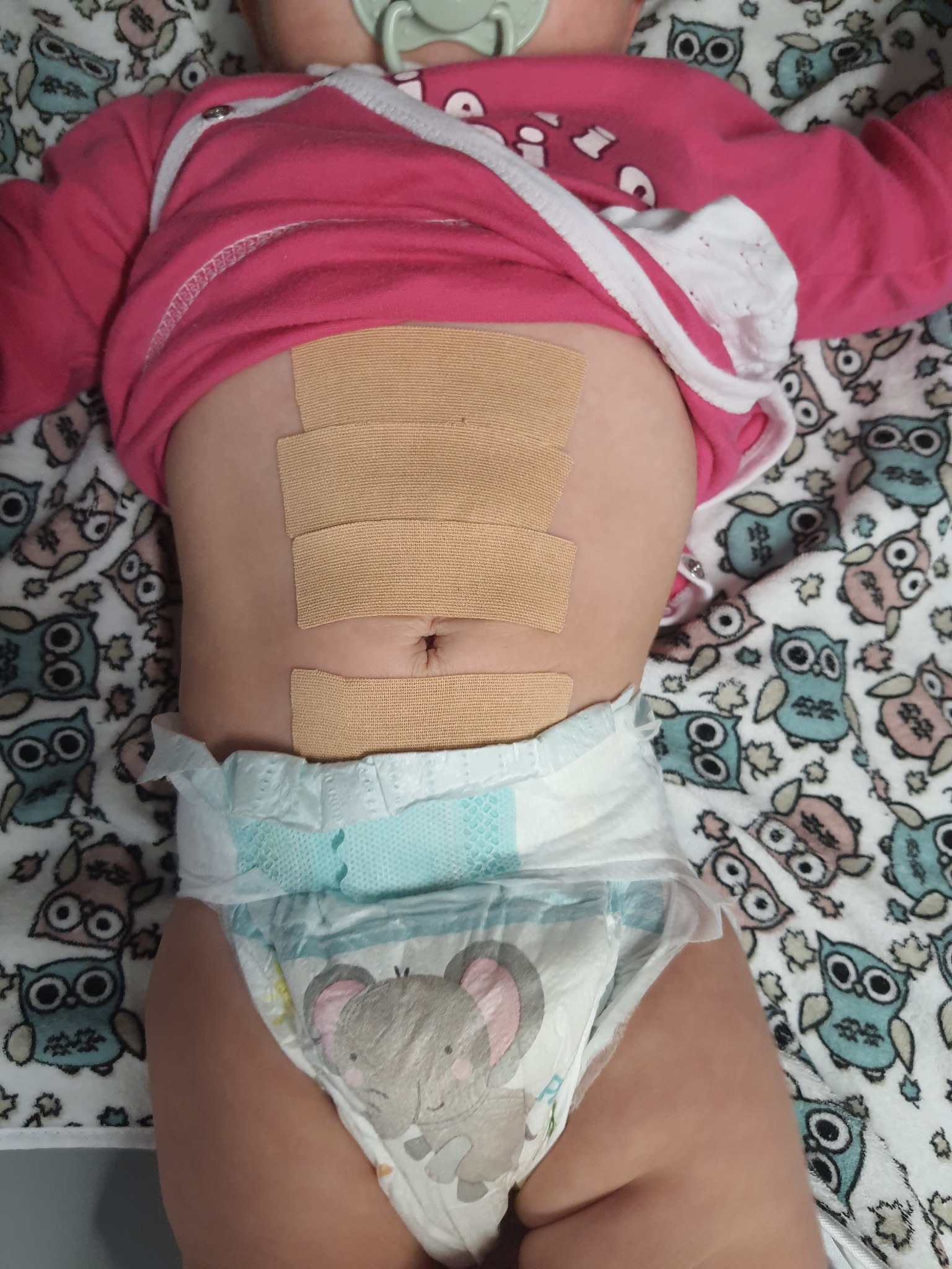 Dziecko leżące na kocyku w pieluszce, z czterema plastrami opatrunkowymi na brzuchu po zabiegu lub terapii.