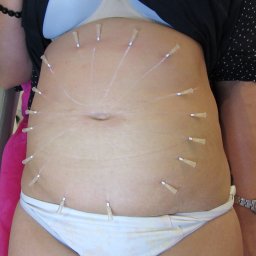 Zabiegi na ciało Poznań 2