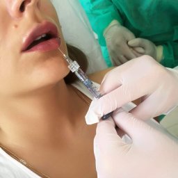 OtoJa Medycyna Estetyczna - Powiększanie ust kwasem hialuronowym: igła wprowadzana w czerwień wargową, widoczne rękawice ochronne lekarza i strzykawka z preparatem, delikatne linie zmarszczek wokół ust.