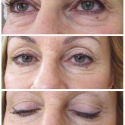 OtoJa Medycyna Estetyczna - Trzy zbliżenia na oczy kobiety: pierwsze z otwartymi oczami i widocznymi rzęsami po zabiegu, drugie z otwartymi oczami i widocznymi zmarszczkami, trzecie z zamkniętymi oczami i widocznym makijażem...