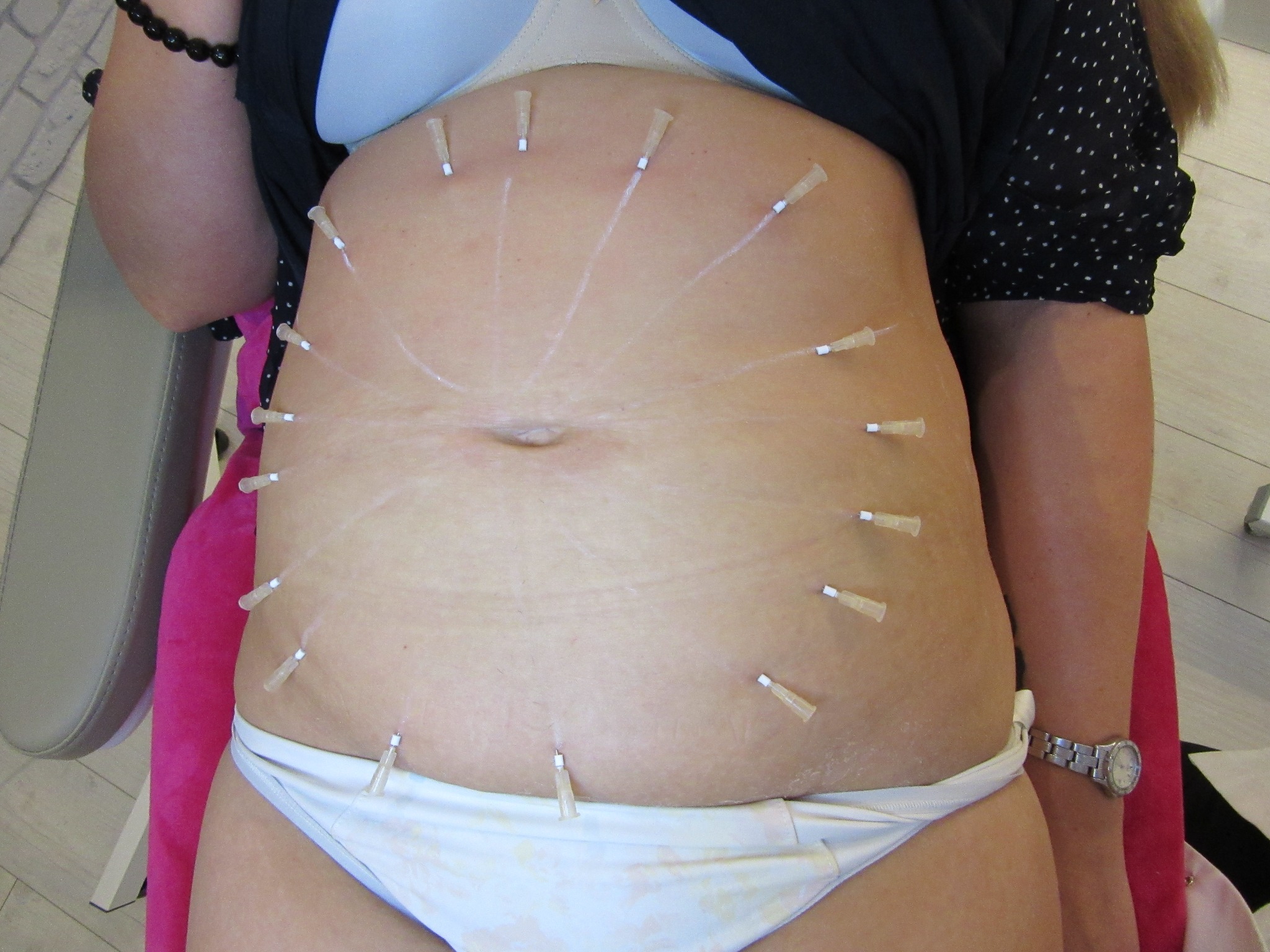 Brzuch pacjentki przed zabiegiem z zaznaczonymi punktami i igłami do mezoterapii igłowej, widoczne ślady po markerze.