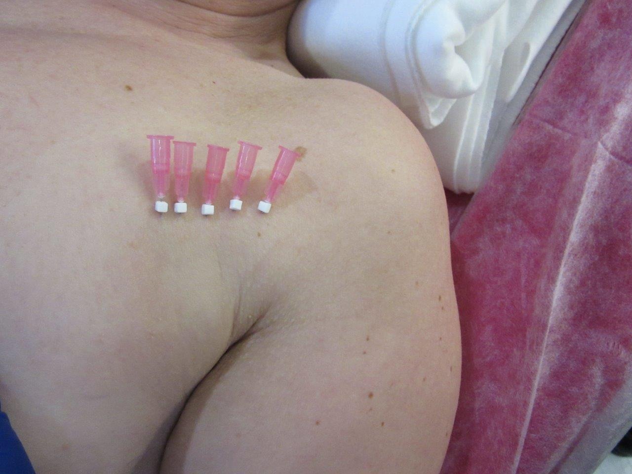 Klatka piersiowa pacjenta z czterema różowymi kaniulami dożylnymi wpiętymi w skórę, przygotowanie do zabiegu, widoczne drobne znamiona na skórze.