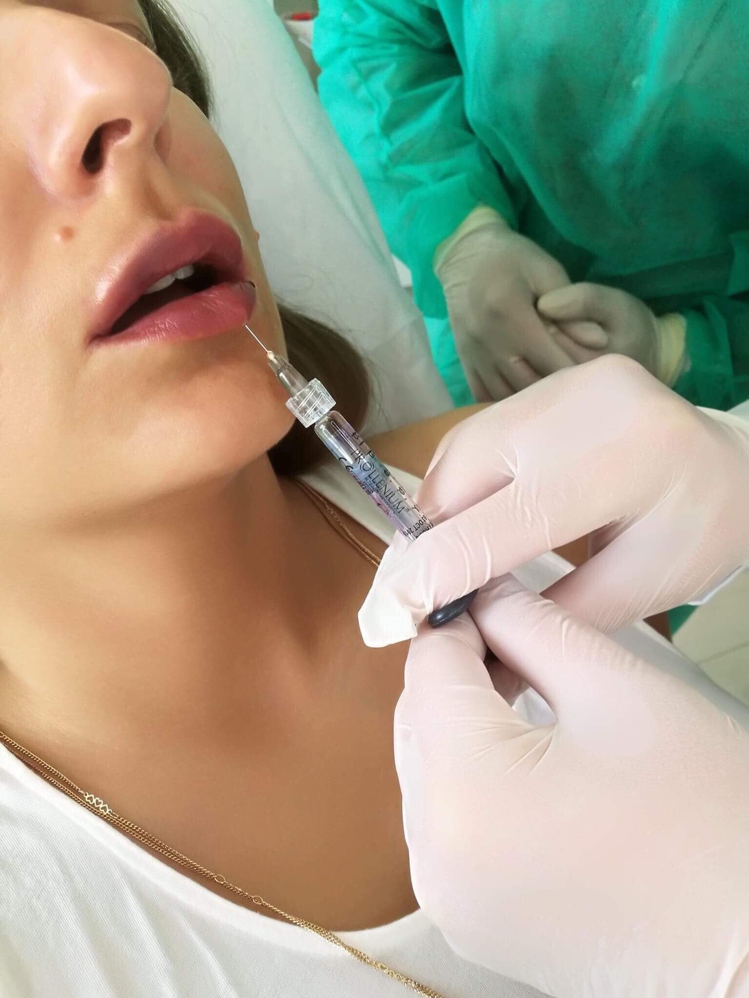 Powiększanie ust kwasem hialuronowym: igła wprowadzana w czerwień wargową, widoczne rękawice ochronne lekarza i strzykawka z preparatem, delikatne linie zmarszczek wokół ust.